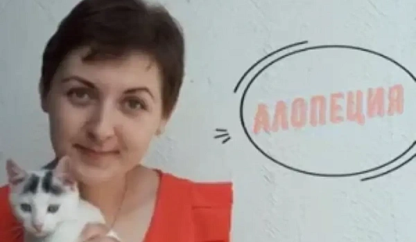 #СамоеВремяЖить: Алопеция